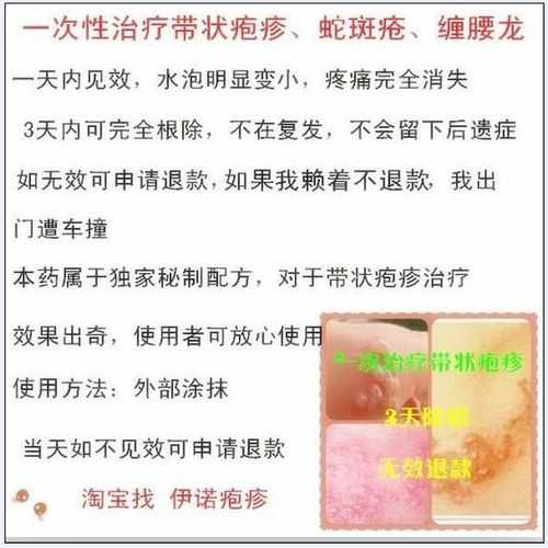 蛇斑怎么治最有效（蛇斑疮怎么治疗有效）