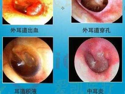 得了耳道炎怎么办（得了耳道炎怎么办才好得快）