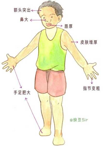 犬肢端肥大症（犬肢端肥大症胰岛素抵抗怎么办）