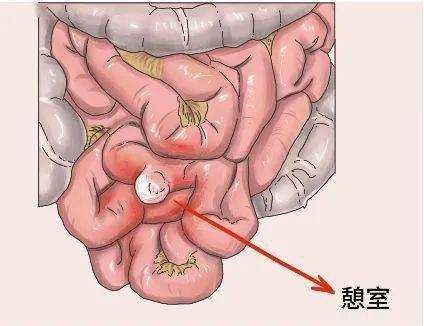 先天结肠憩室病如何治疗（先天性结肠憩室）